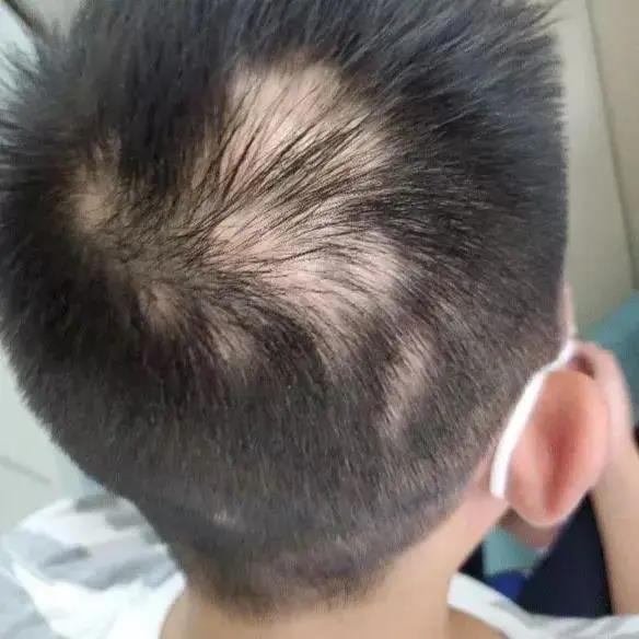 12歲男孩，學到頭禿